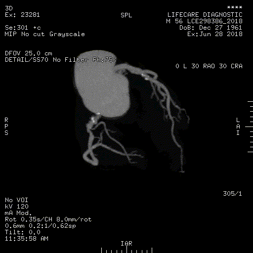 CT Scan Coronary