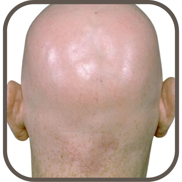 Are you suffering from Hair Loss (Alopecia)?
