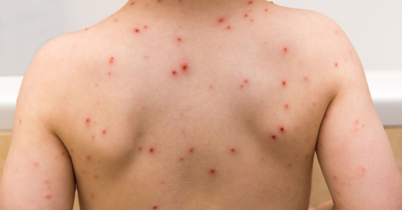 chicken-pox-1.jpg