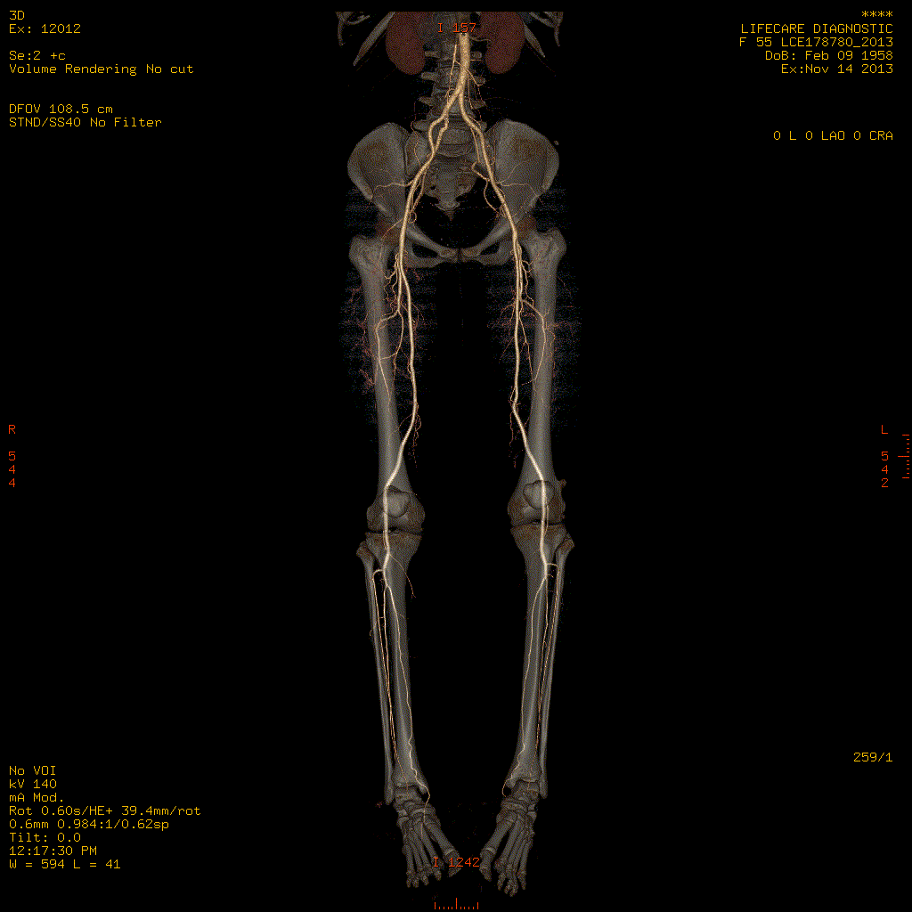 CT Scan-Lower Limb