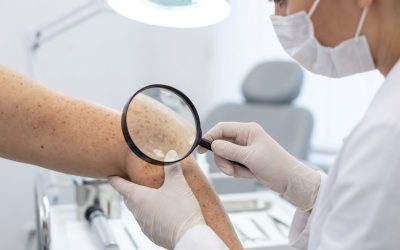 A doctor in gloves uses a magnifying glass to check moles on a patient arm. Professional medical
